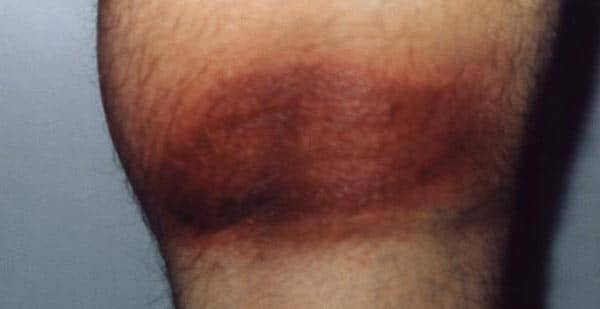 This dark rash was the result of Lyme disease.