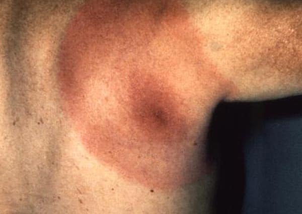 A circular rash such as this may indicate you have Lyme disease. Even if you don't know you were bitten by a tick or have other symptoms you should see a doctor immediately.