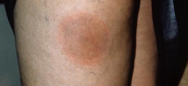 A small circular rash is a tell-tale sign of Lyme disease. But be aware that many people with this disease don't develop a rash, so look for other symptoms as well.