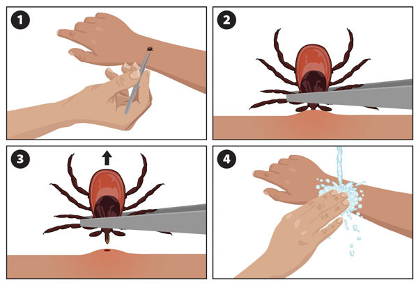 To remove a tick, use tweezers to grasp it at the point of attachment and pull upwards.